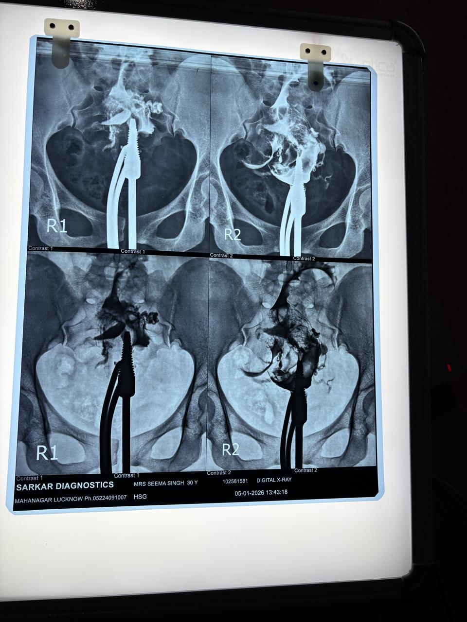 Successful Management of Tubal Ectopic Pregnancy